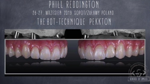 BDT Technique, Phill Reddington Konstrukcje Pekkton i korony całoceramiczne